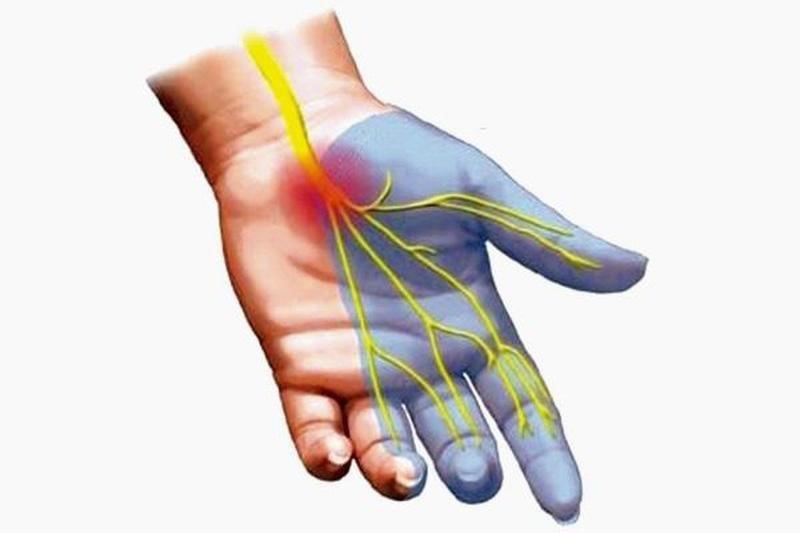 Biến chứng thần kinh có thể gây tê bì, mất cảm giác.