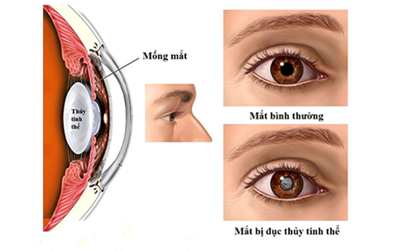 Cảnh báo: Biến chứng đục thủy tinh thể do tiểu đường có thể gây mù mắt 