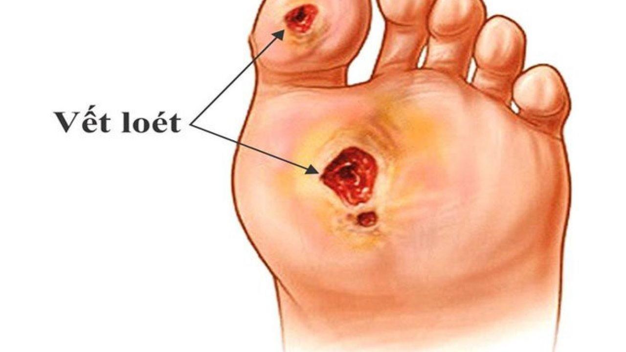 Người bệnh tiểu đường và nguy cơ nhiễm trùng luôn rình rập