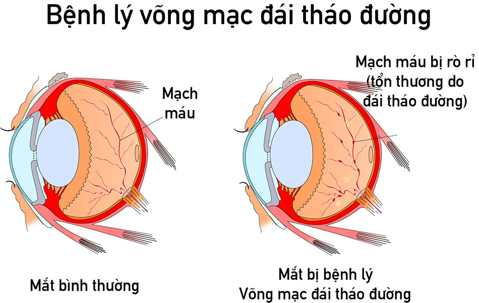 Tiểu đường sẽ khiến thị lực của người bệnh suy giảm