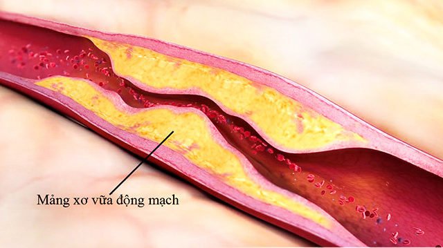 Xơ vữa động mạch - biến chứng nguy hiểm của bệnh tiểu đường