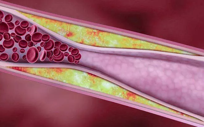 Tăng đường huyết và kháng insulin khiến các mảng xơ vữa dễ hình thành
