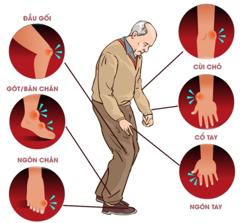 Bệnh Gút có chữa được không?