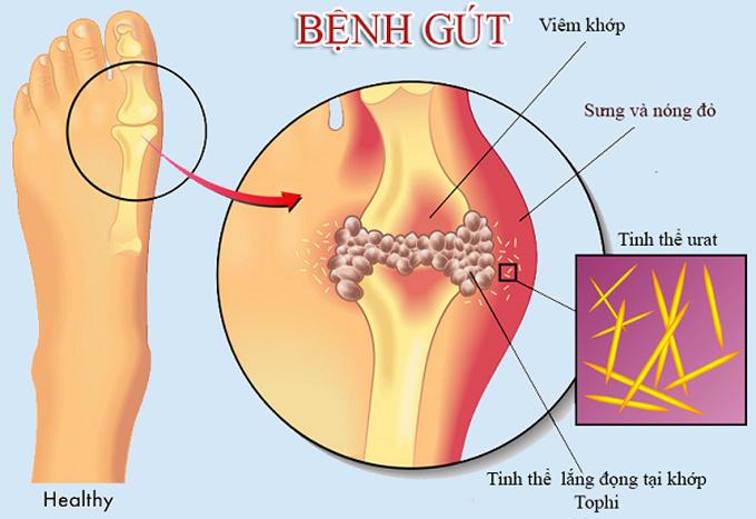 Lắng đọng tinh thể natri urat tại khớp gây bệnh gút