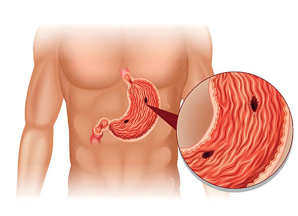 Corticosteroid có nguy cơ gây loét dạ dày