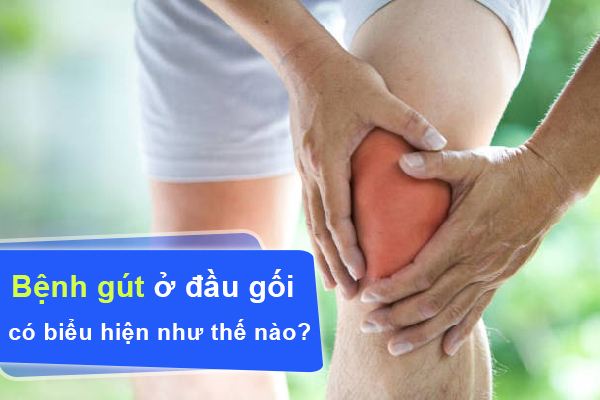 Bệnh gút ở đầu gối có biểu hiện như thế nào? Làm sao để cải thiện?