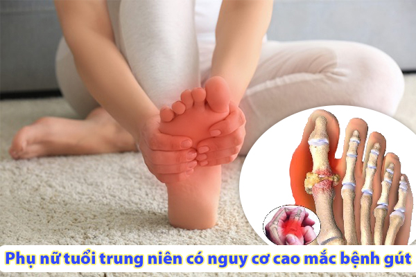 Phụ nữ tuổi trung niên có nguy cơ cao mắc bệnh gút