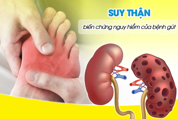 Suy thận - Biến chứng nguy hiểm của bệnh gút