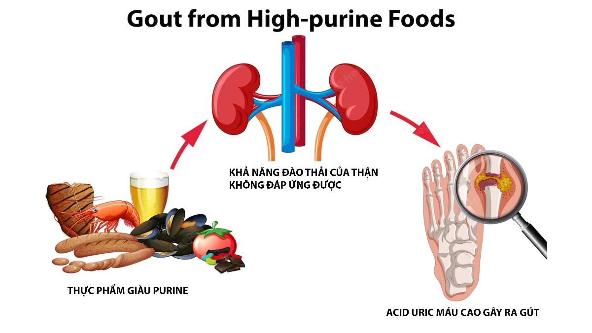 Nguyên nhân gút liên quan ăn uống