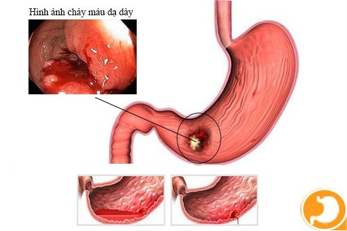Nguy cơ xuất huyết dạ dày khi sử dụng thuốc giảm đau dài ngày