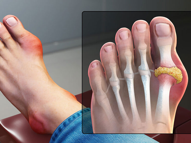 Bệnh gút gây lắng đọng tinh thể muối urat tại các khớp