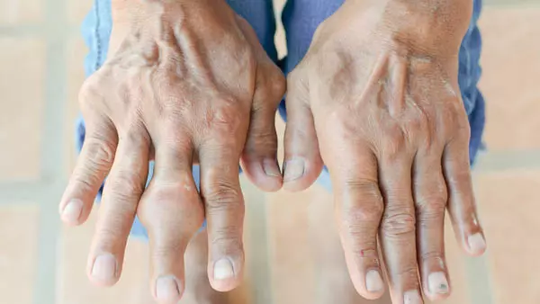 Hạt tophi sẽ khiến các khớp bị biến dạng nghiêm trọng