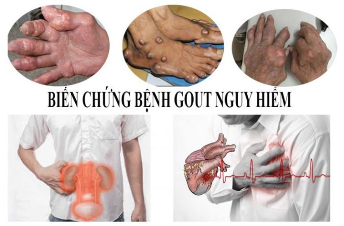 Phòng ngừa biến chứng bệnh gút với BoniGut